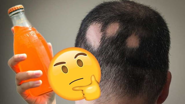 Un estudio ha relacionado el refresco con la alopecia
