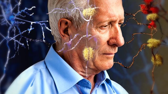 La enfermedad de Alzheimer se relaciona de manera importante con la edad y factores genéticos